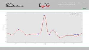 Heart Monitoring ECGenie